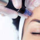 Beneficios del Dermapen con Botox